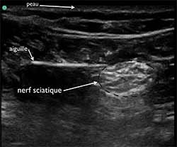 échographie nerf