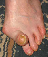 hallux valgus historique