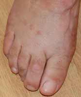 hallux valgus compliqué opéré