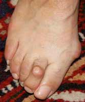 hallux valgus compliqué