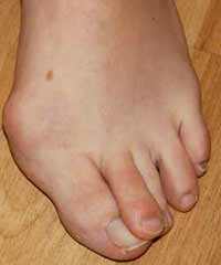 hallux valgus femme jeune