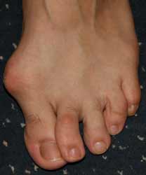 hallux valgus chez l'homme