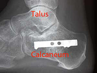 radio du calcaneum