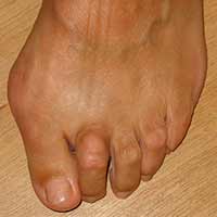 Doigts griffes de hallux forum valgus pieds en douleur du