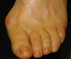 hallux valgus avant chirurgie