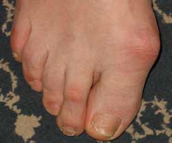 hallux rigidus